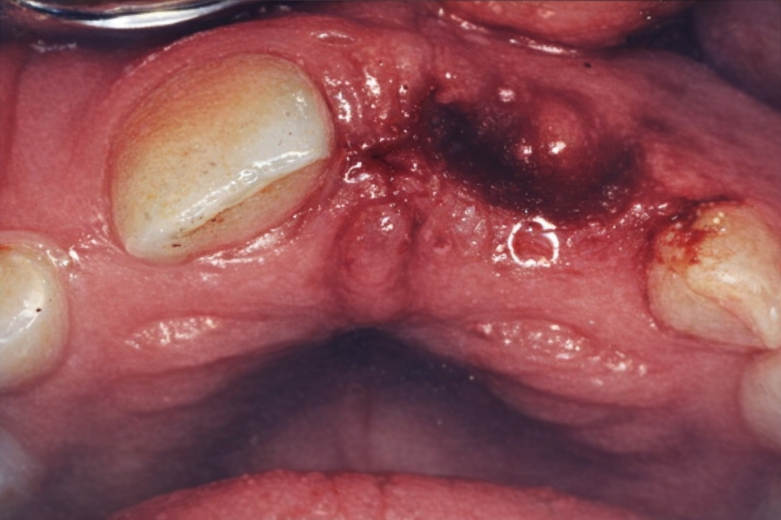 Patient teeth